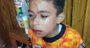 كلب ضال يعقر ويهمش وجه طفل عمره 8 سنوات في اربد